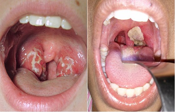 Hỏi đáp về bệnh bạch hầu