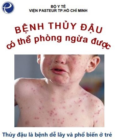Bệnh thủy đậu có thể phòng ngừa được