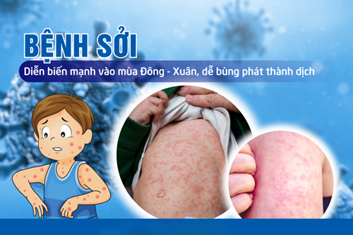 về tuyên truyền và hướng dẫn phòng, chống bệnh Sởi