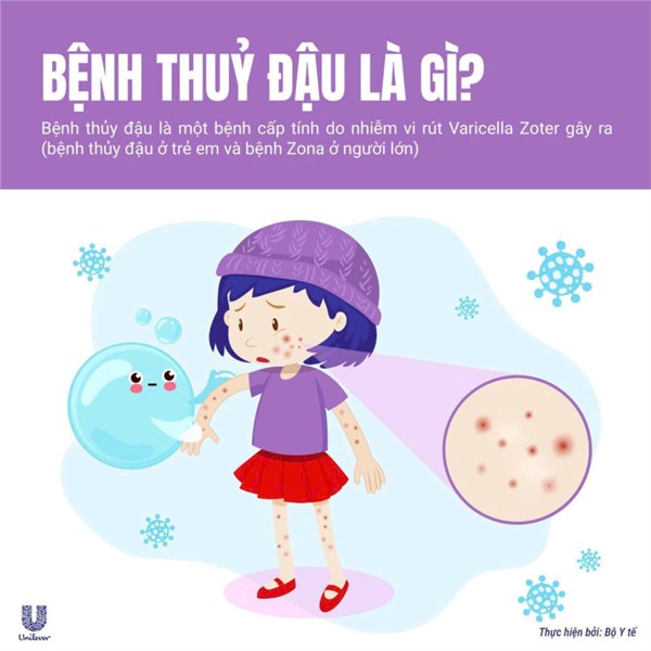 Bài tuyên truyền phòng tránh bệnh thủy đậu