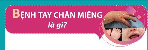 Bệnh tay chân miệng