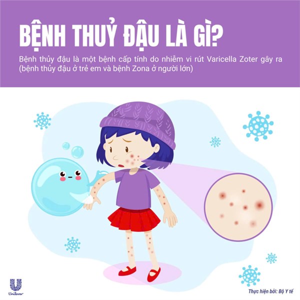 Tuyên truyền phòng bệnh Thủy đậu
