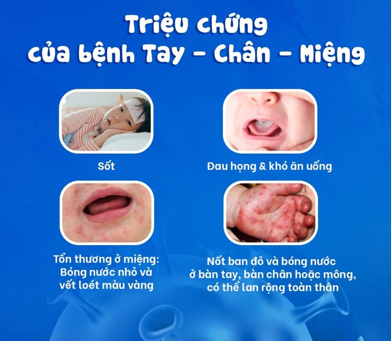 Những triệu chứng nặng của bệnh tay chân miệng